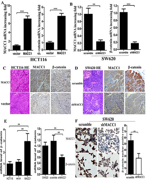 MACC1 and &#x3b2;-catenin mRNA (A-B) and protein (C-D) expression were much increased or decreased in enucleated tumors derived from HCT116 cells stably transfected with MACC1 over-expression plasmid or SW620 stably transfected with shMACC1 compared with the control group by real-time PCR and immunohistochemistry staining (&times;400), respectively; &#x3b2;-catenin mRNA expression was dramatically increased or decreased in HCT116 with MACC1 over-expression or SW620 cells with shMACC1 compared with the control groups by real-time PCR analysis (E); MACC1 and nuclear &#x3b2;-catenin protein expression was dramatically decreased in SW620 cells with shMACC1 compared with the control group by immunohistochemistry staining, &times;400.
