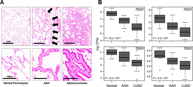 Progressive down-regulation of TBX2 subfamily in premalignant and malignant lung tissues.