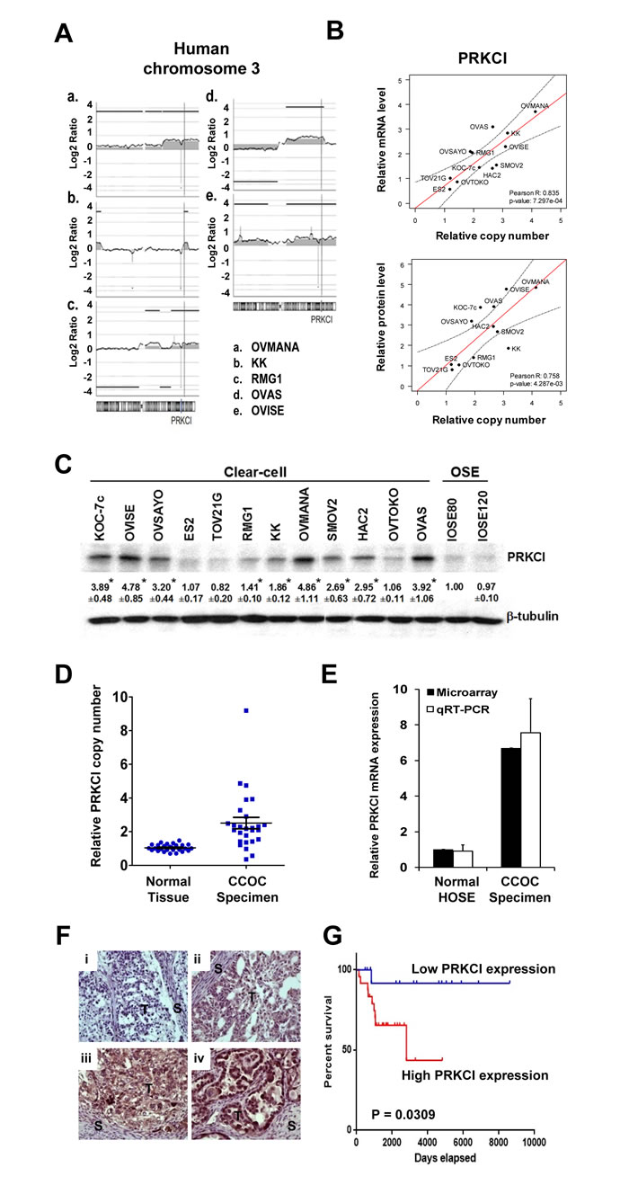 PRKCI amplification and overexpression in CCOC cells and patient specimens.