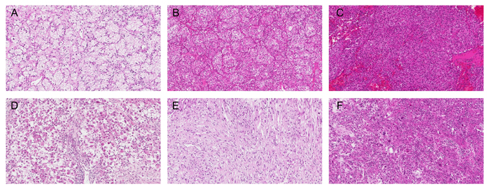 Cytoplasmic features of ccRCC based on adipogenesis.