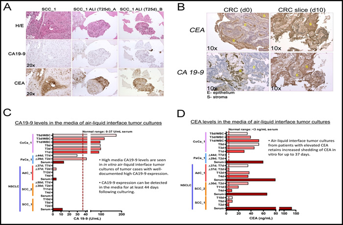 3D air-liquid interface (ALI) lung cancer