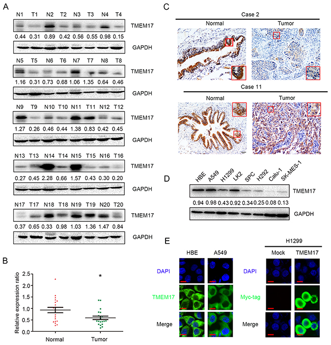 The expression of TMEM17 in NSCLC specimens.