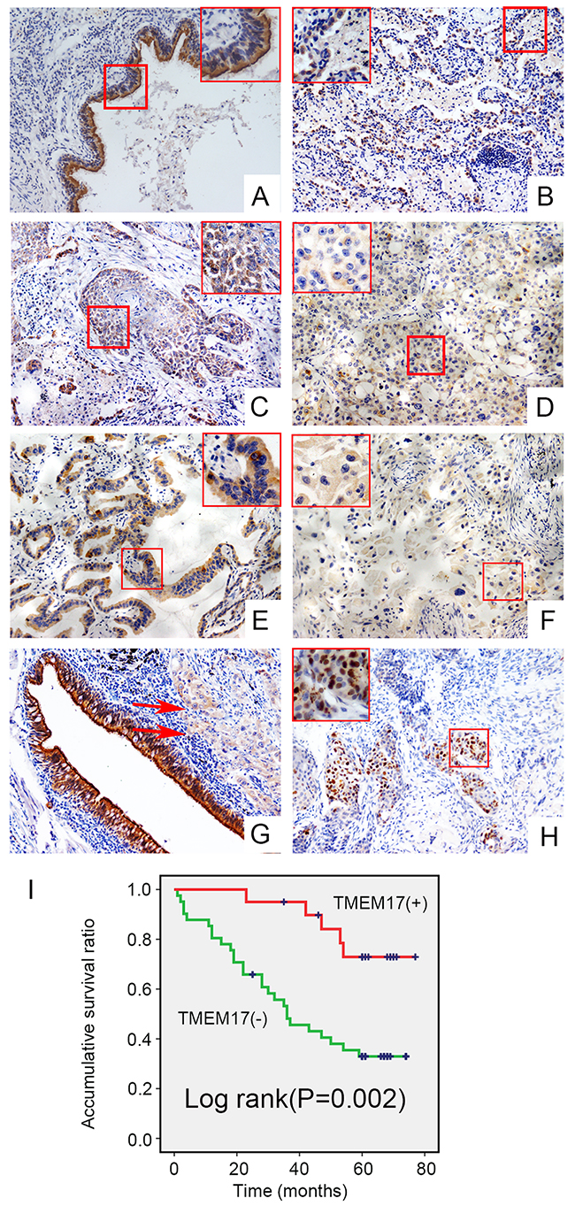 The expression and subcellular localization of TMEM17 in NSCLC tissues and cell lines.