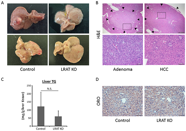 Hepatic neoplastic lesions and steatosis in the experimental mice.