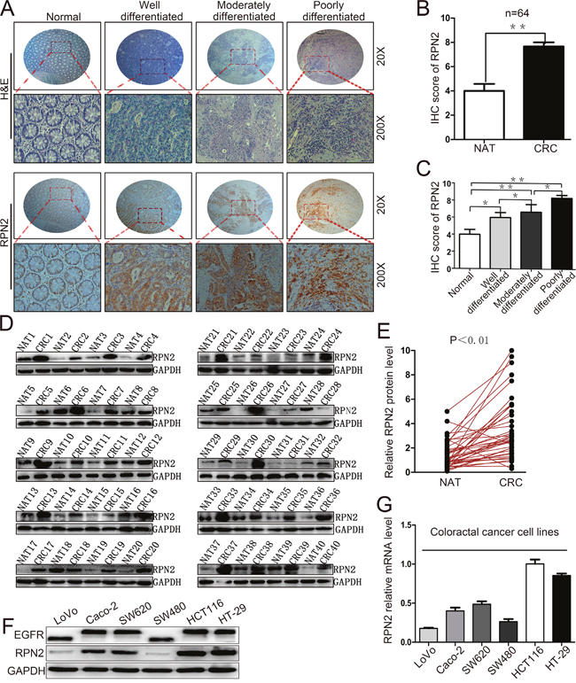 Upregulation of RPN2 is related to tumor growth in colorectal cancer.