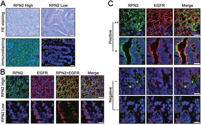 Status of RPN2 and EGFR in human colorectal cancer tissues.