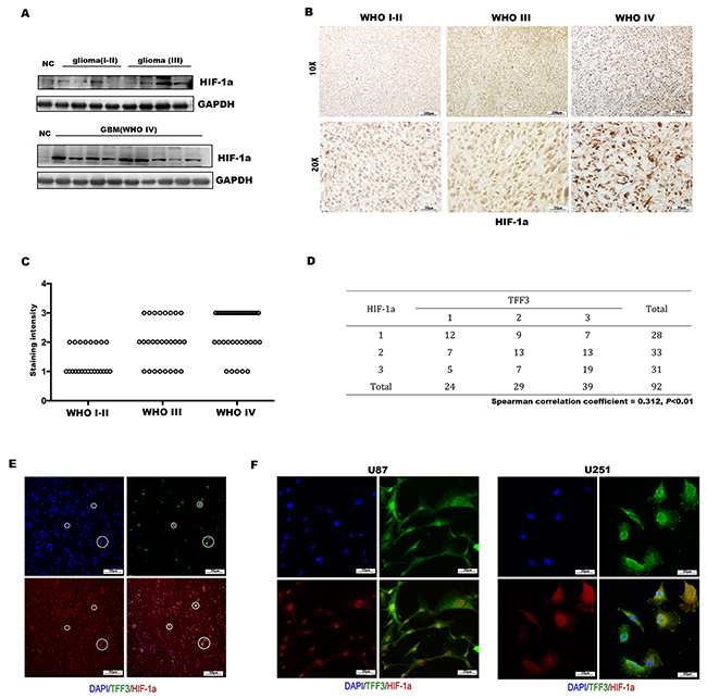 Expression of HIF-1&#x03B1; in glioma and correlation with TFF3.