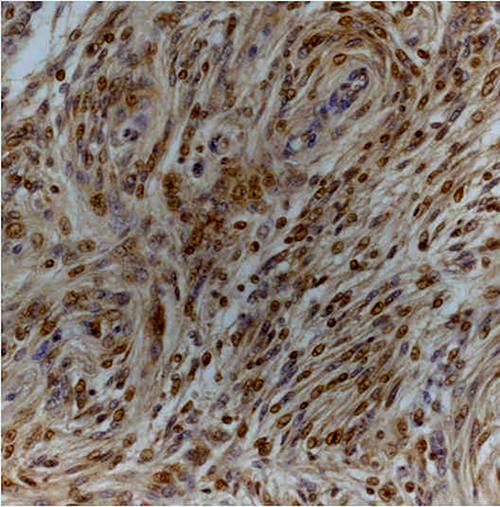 Transitional (grade I) meningioma showing moderately intense cytoplasmic and nuclear staining for Dkk3 (Dkk3 stain; original magnification, x200).
