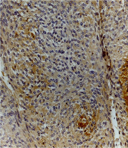 Meningothelial meningioma (grade I) showing moderate cytoplasmic staining for claudin-5 (claudin-5 stain; original magnification, x200).