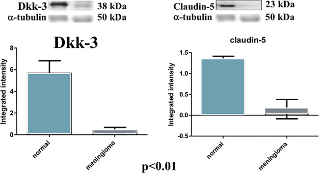 Evident decrease, at western blot analysis, of Dkk-3 and claudin-5 expression in the tissues of patients with meningiomas compared with control tissues.