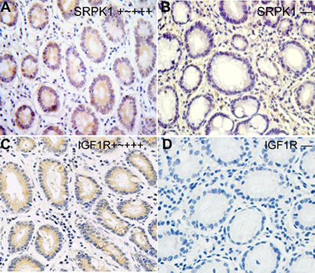 Expression status of SRPK1 and IGF1R protein in gastric cancer tissues.