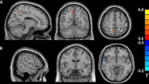 Figure 1. Brain regions showing different fALFF values between individuals with and without childhood trauma (p &#x003C; 0.05, AlphaSim corrected).