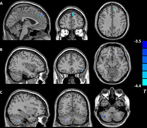 Brain regions showing decreased right precuneus-based functional connectivity in individuals reporting childhood trauma.