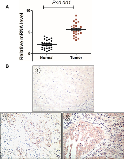 MMP16 expression patterns in HCC tissues.