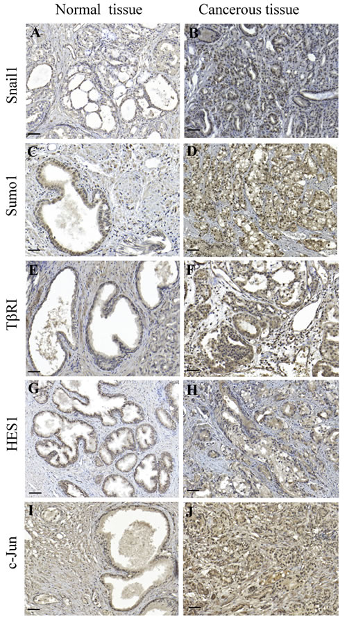 Immunohistochemical staining&#x2019;s for Snail1, Sumo1, T&#x3b2;RI, Hes1, and c-Jun correlates with malignancy of prostate cancer tissues.