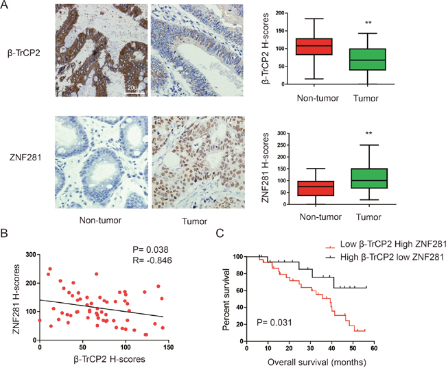 Expression patterns of &#x03B2;-TrCP2 and ZNF281 in human CRC.