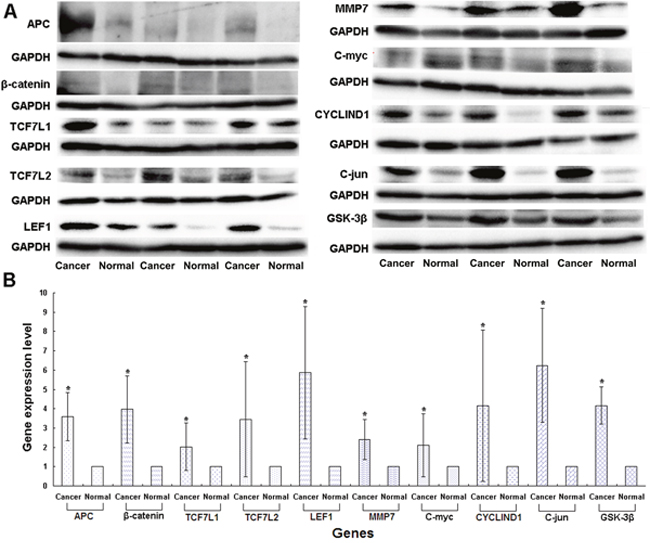 Expression levels of genes in the Wnt/&beta;-catenin signaling pathway in CRC patients detected in the p.1125Val>Ala mutant FAP family patients by Western blotting.
