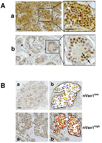 Nuclear expression of Vav1 in breast cancer tissues.