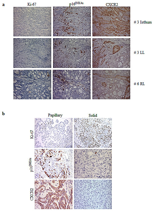 Immunohistochemical analysis for the expression of Ki-67, p16
