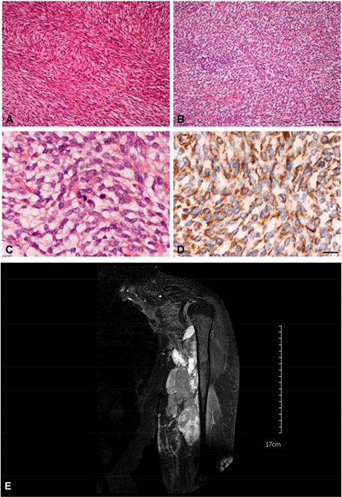 Histology and MRT of a typical case of an adult fibrosarcoma (FNCLCC grade 2).