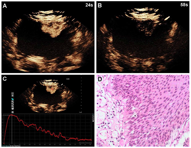 A 60-year-old woman with low-grade bladder cancer on the anterior bladder wall.