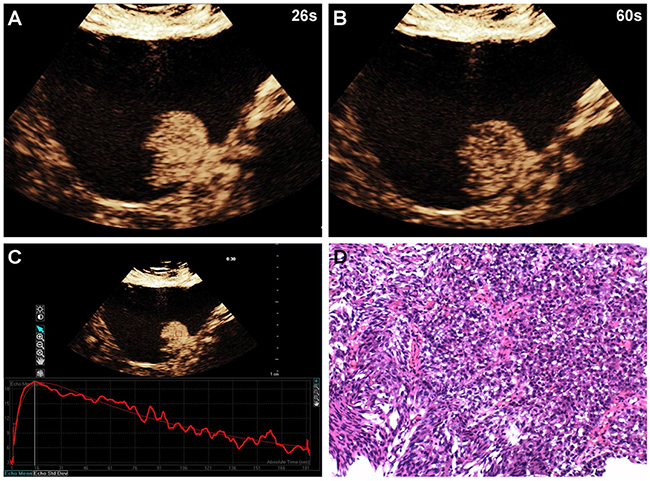 A 58-year-old man with high-grade bladder cancer on the posterior bladder wall.