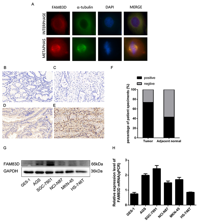 Expression of FAM83D in human gastric tumor tissues and cell lines.