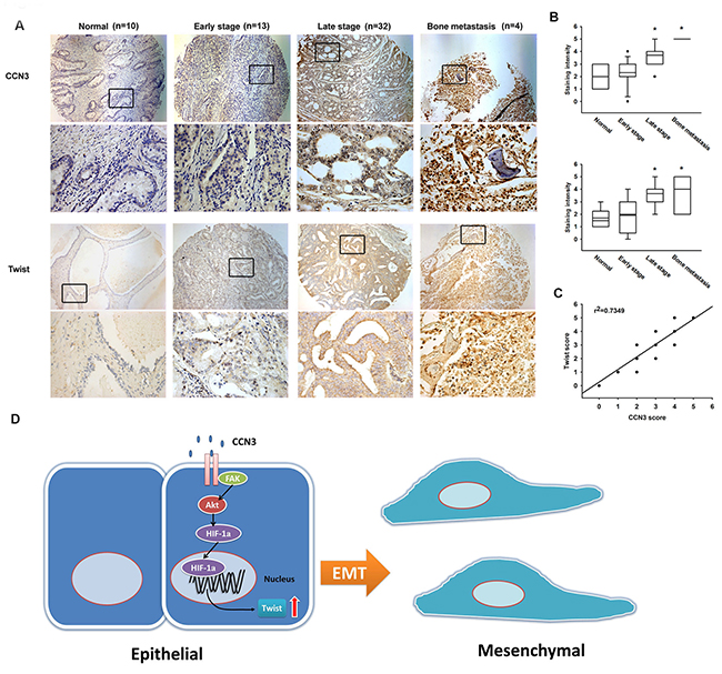 Prostate cancer specimens show significant correlations between CCN3, Twist expression and tumor progression.