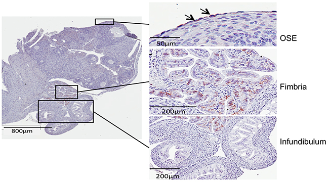 Immunohistochemistry shows CD44 staining only in the fimbriae and a few cells in the ovarian surface epithelium.