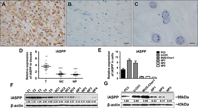 iASPP expression in chordoma tissues and cells.