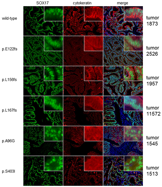 Mutated and wild-type tumors display similar SOX17 expression patterns.