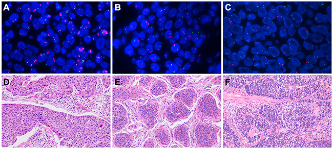 Fibroblast growth factor receptor 1 (FGFR1) amplification assessed by fluorescent in situ hybridization and the corresponding hematoxylin-eosin (HE) staining.