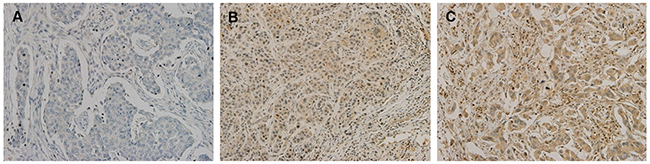 Immunohistochemical analysis of cIAP2 in triple-negative breast cancer tissues.