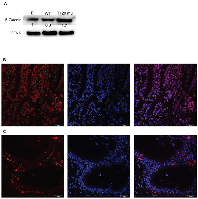 PrKD1 down regulation or representative condition (beta-catenin T120 mutation) increases nuclear beta-catenin in vitro and in vivo.
