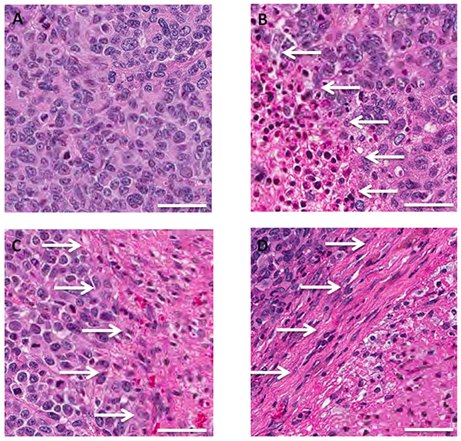 Tumor histology in untreated and TEM and rMETase-treated BRAF-V600E mutant melanoma PDOX models.