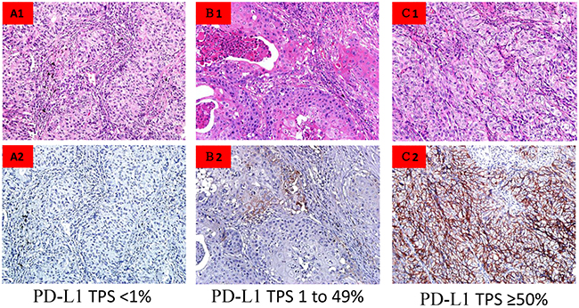 PD-L1 immunohistocehmistry labeling in NSCLC tumor specimens.
