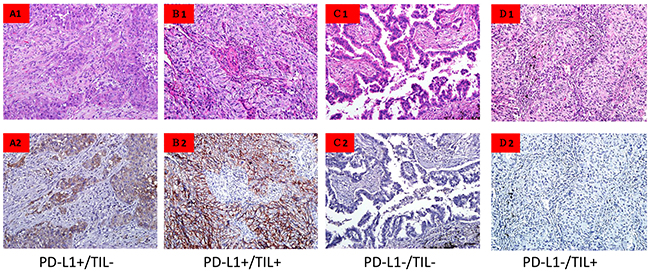 Tumor cell PD-L1 expression and lymphocytic infiltration.