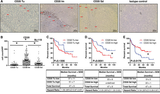 Localized infiltration of CD20+ cells within the infiltrative margin is associated with increased patient survival.