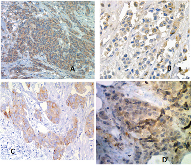 Immunohistochemistry of most significant factors associated with response to neo-adjuvant treatment.