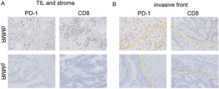 PD-1 and CD8 expression of dMMR and pMMR CRC specimens.