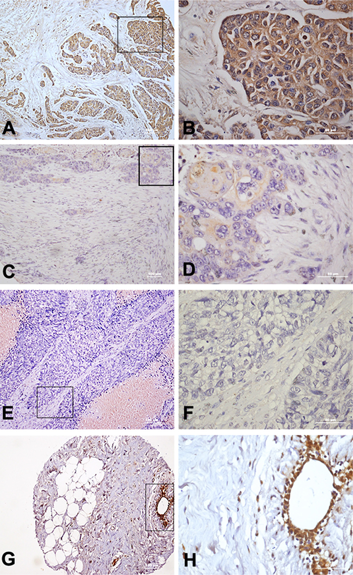 Immunohistochemical staining of TLR5 protein in breast cancer tissues.