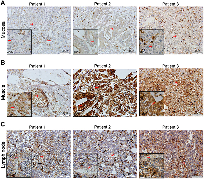 Different expression of CD163 in gastric mucosa, muscle layer and metastatic lymph node.