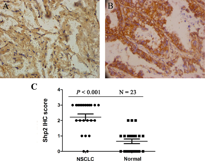 Shp2 expression is increased in non-small cell lung cancer (NSCLC).
