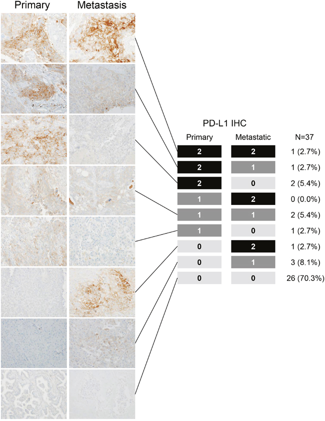 Programmed death-ligand 1 (PD-L1) expression levels in paired surgically resected primary and metastatic tissues with representative PD-L1 immunohistochemistry images.