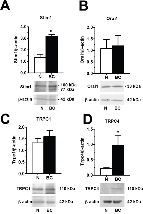 Orai1, Stim1, TRPC1 and TRPC4 proteins are up-regulated in breast cancer-associated endothelial colony forming cells.