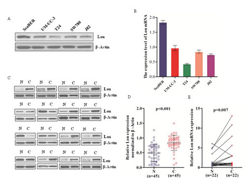 Lon expression in various human bladder cancer cell lines and 45 pairs of bladder cancer tissues and matched normal tissues.