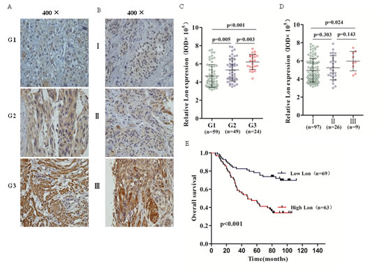 Immunohistochemical (IHC) staining of Lon protein in bladder cancer tissues and