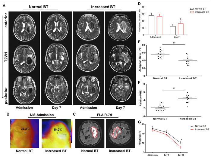 Increased brain temperature reduced hematoma absorption and aggravated neurological deficits in intracerebral hemorrhage (ICH) patients.