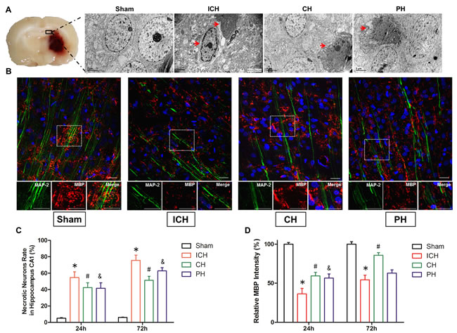 Neuronal necrosis and demyelinating injury induced by intracerebral hemorrhage (ICH) was improved by hypothermia.