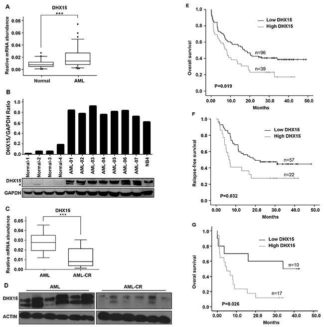 Prevalence and prognostic impact of DHX15 overexpression in acute myeloid leukemia.